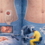 Webinar “Reconstitución de Tránsito Post Cirugía de Hartmann. Buscando El Mejor Abordaje”